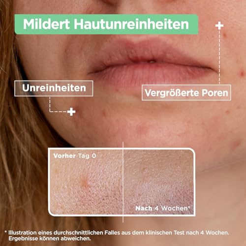 Mixa Anti-Unreinheiten Serum, Für zu Akne neigende und sensible Haut, Mit Salicylsäure, Squalan und Niacinamid, Geeignet für Gesicht & Hals, Hypoallergen, 30 ml