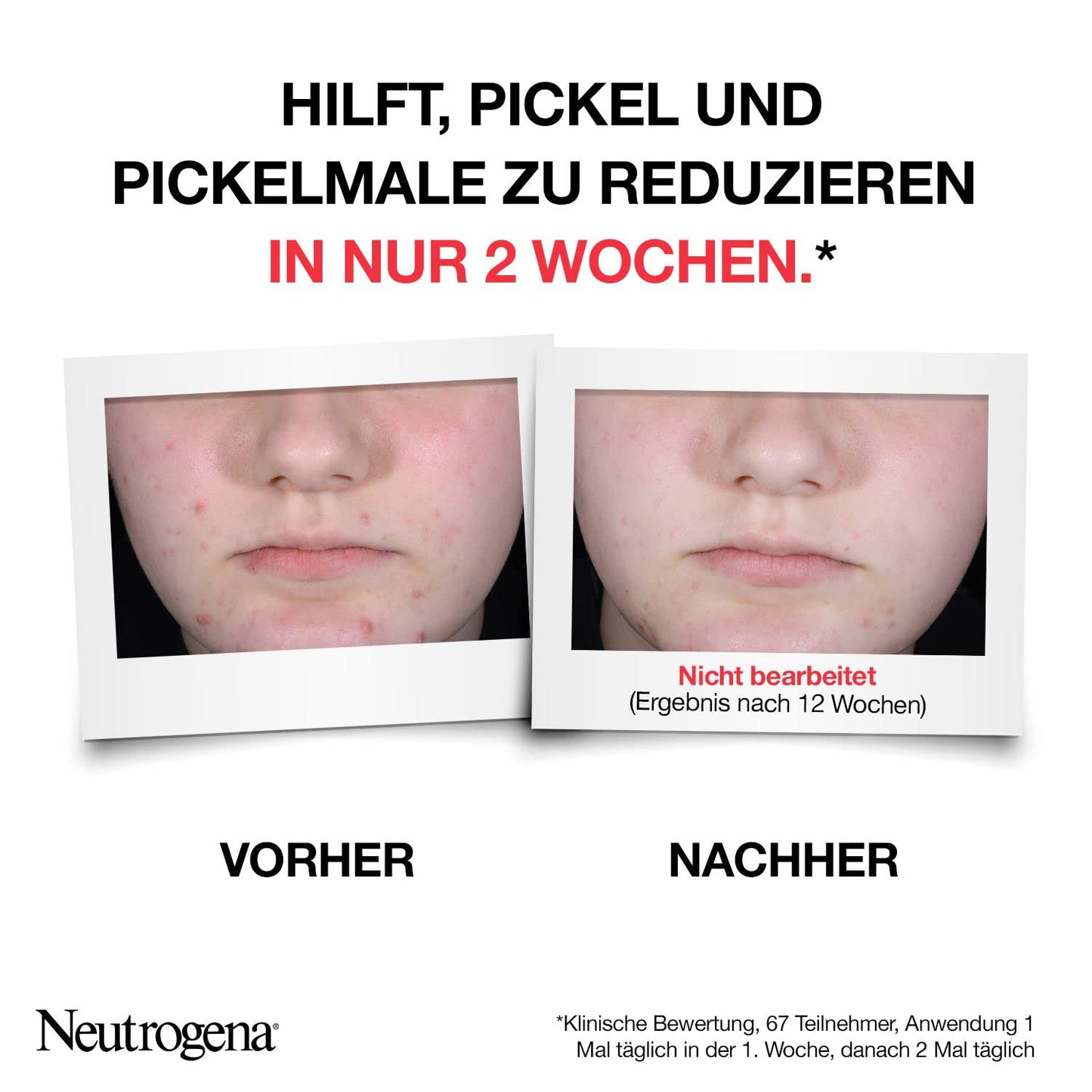 Neutrogena Anti-Pickel+ Peeling Serum (30 ml), hautbilderneuerndes Gesichtsserum mit hautklärender Salicylsäure + AHA/PHA für unreine Haut, reduziert Pickel & Pickelmale sichtbar in nur 1 Woche*