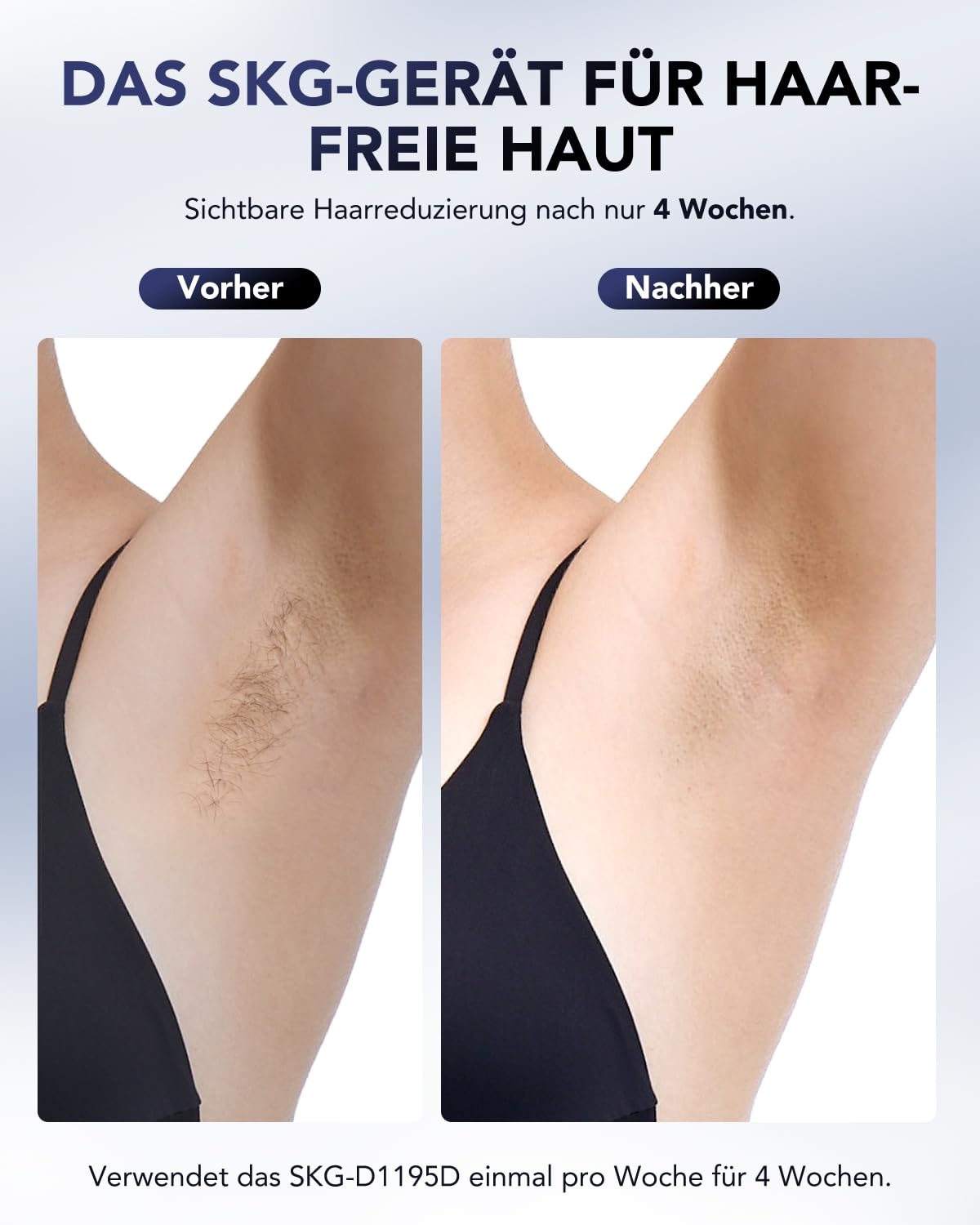 SKG IPL-Haarentfernung für Frauen und Männer, fast schmerzfreie Ergebnisse, sicher und langanhaltend zur Reduzierung des Haarwachstums für Körper und Gesicht.